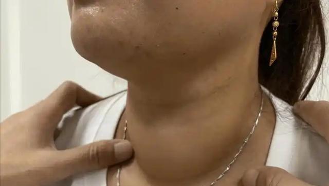 在许多人眼中，甲状腺的健康与饮食息息相关，常听到“多吃海鲜会伤害甲状腺”这样的说