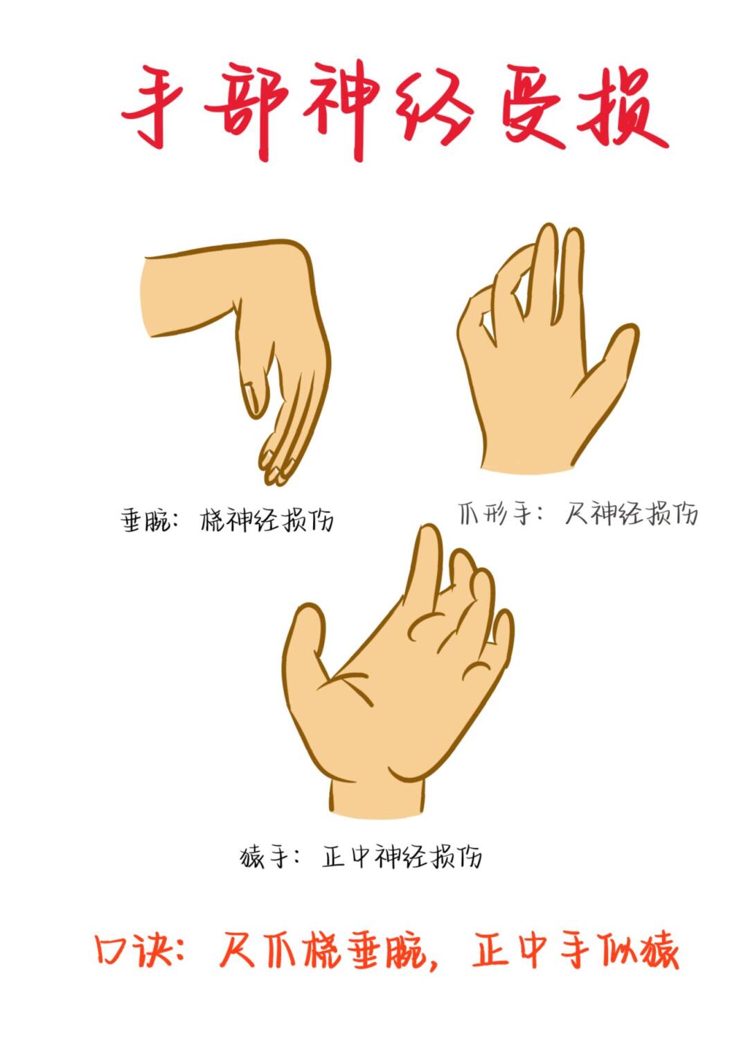 医学生笔记——手部神经受损