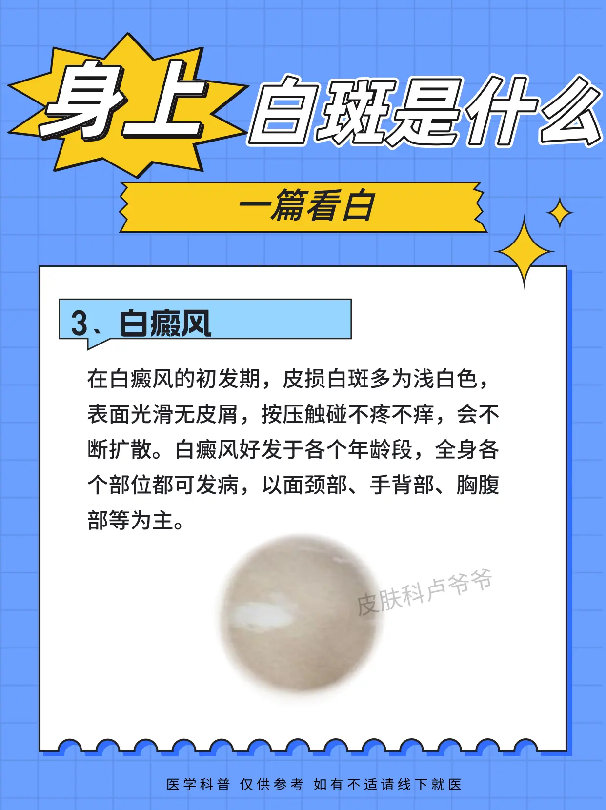 白斑不一定是白癜风