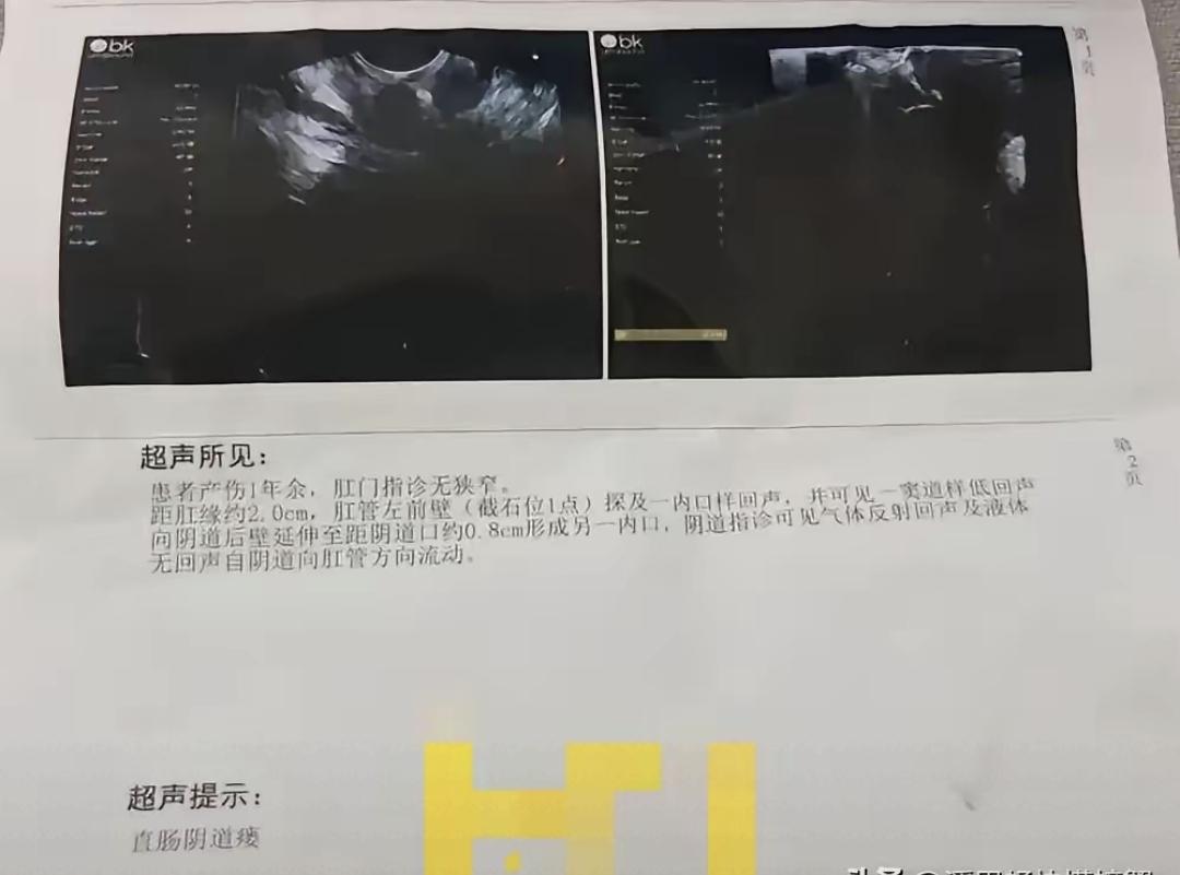 顺产第三天，大便从阴道流出来，医生却说“没事”。
李霞在任丘市人民医院生完孩子，