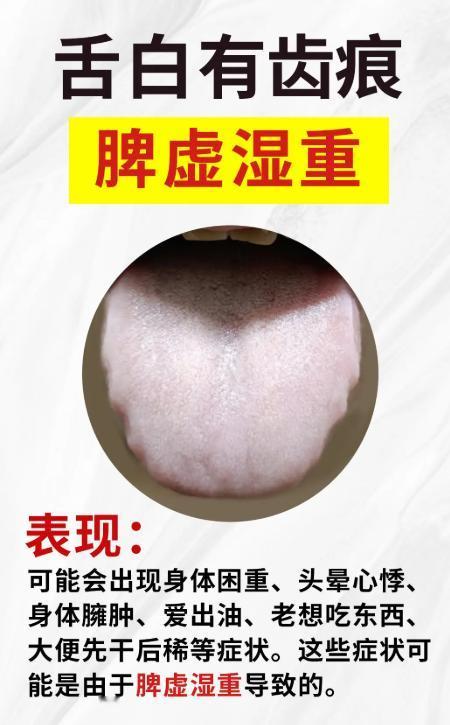 从舌象辨体质：脾虚湿重、寒气积滞等 4 型详解