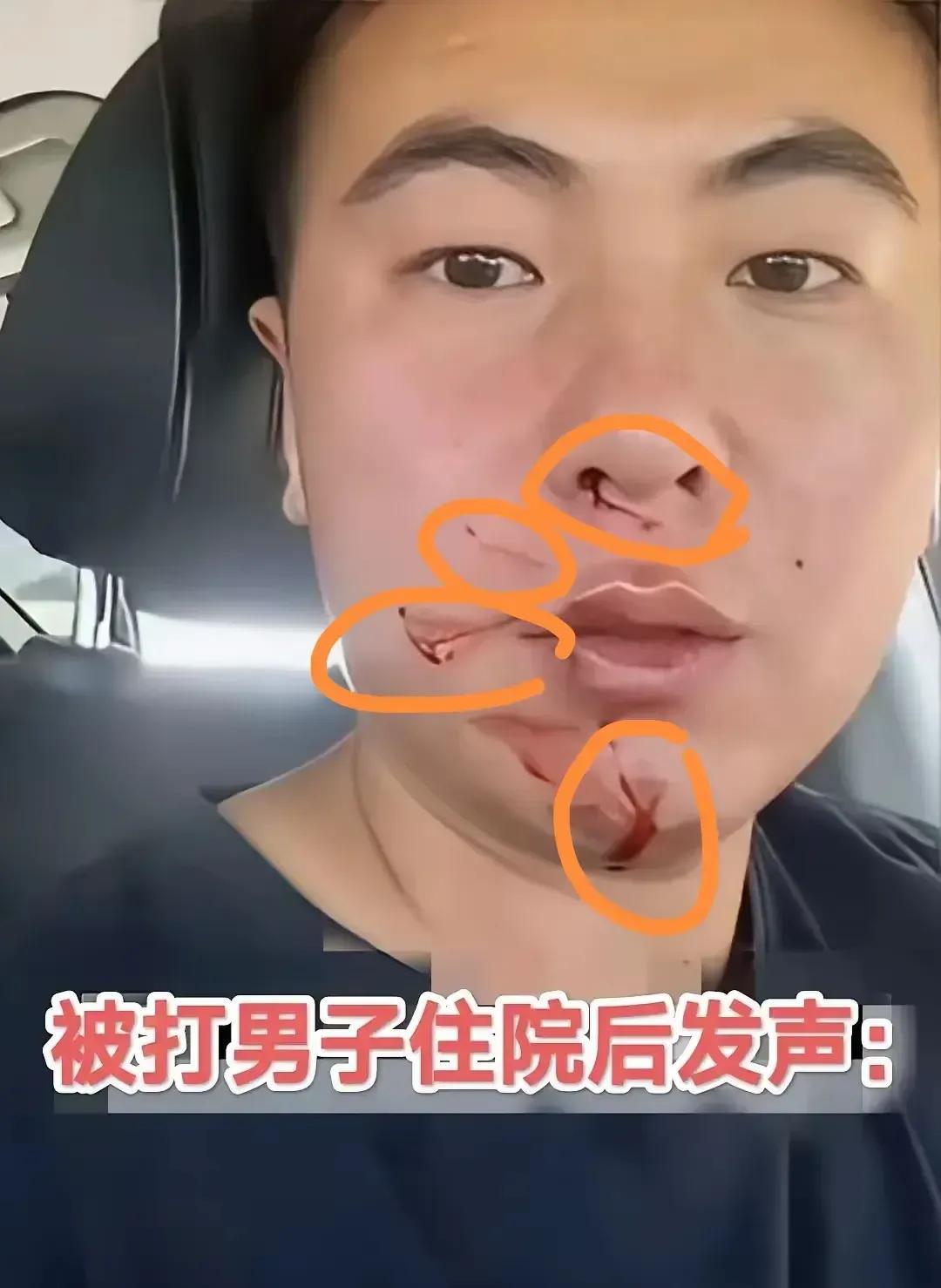 这哥们流的鼻血真的和周星驰不一样