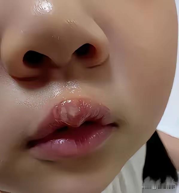 江苏丰县一幼儿园幼师拿热熔枪烫孩子嘴这个事件上热搜了。

说起来这件事，说真的，