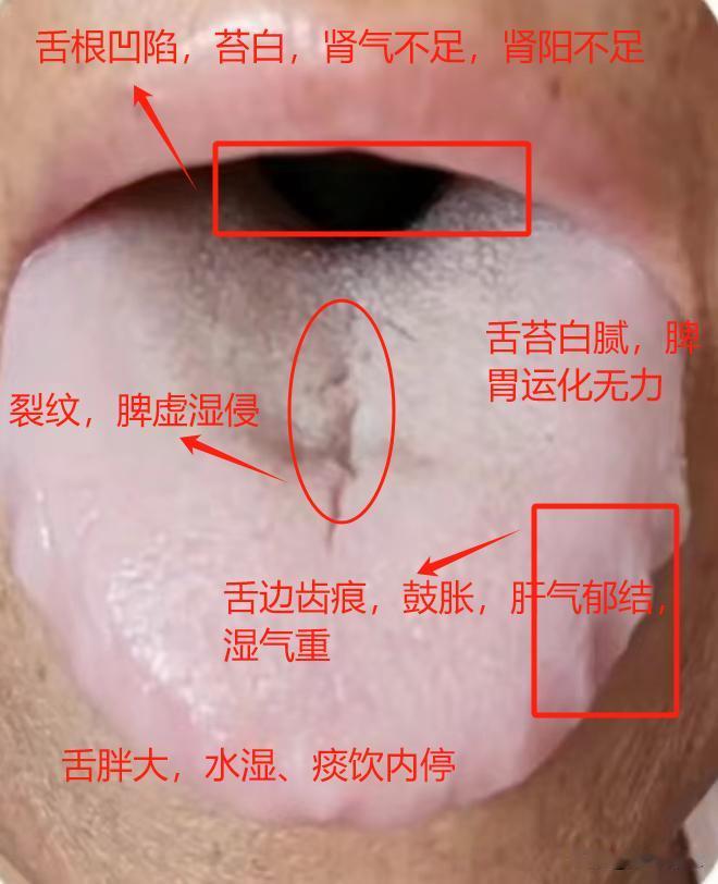 门诊上最常见的两种舌象，简单给大家标注一下，有需要的可以自己对照一下[击掌][击