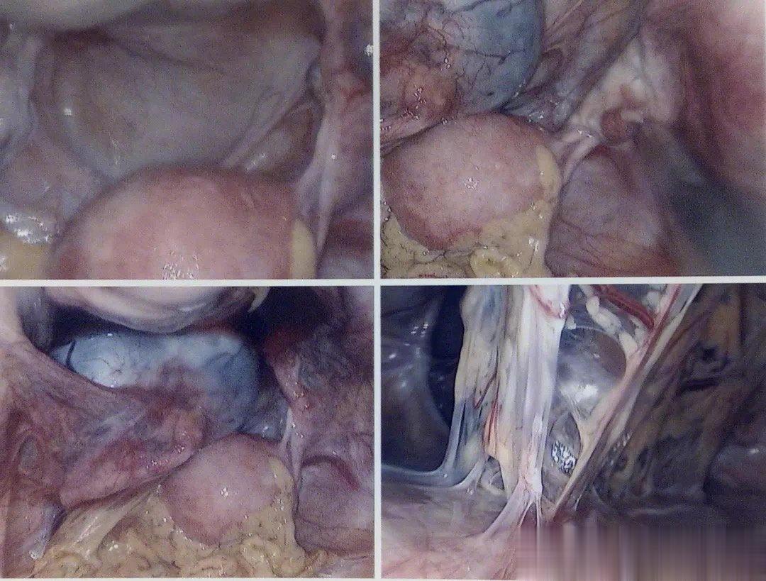 她确实疯了，为什么治好她疯病的，却是妇科医生给她做的手术？这是一种并不少见的疾病