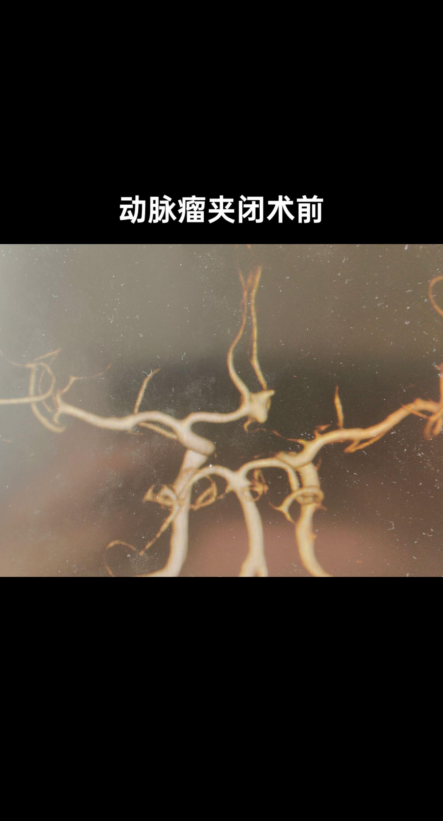 医学科普 医者仁心 手术室日常 医学影像 血管