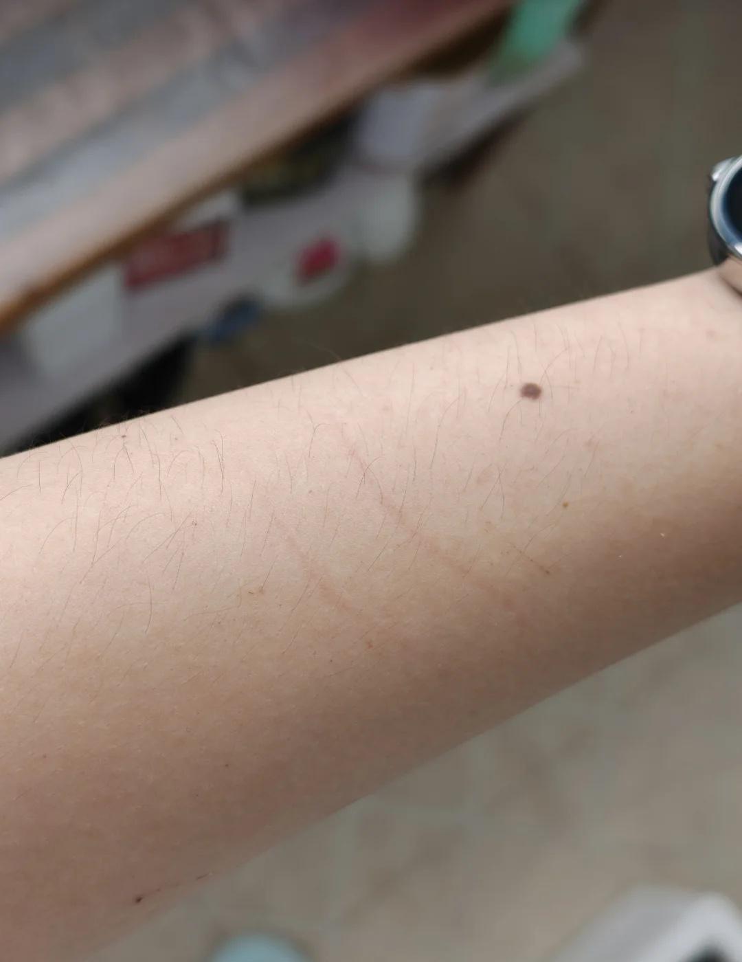 养鸟人的夏天😭
胸口和肩膀更是重灾区……
孩子太黏人了了，老母亲被黏得嗷嗷叫并
