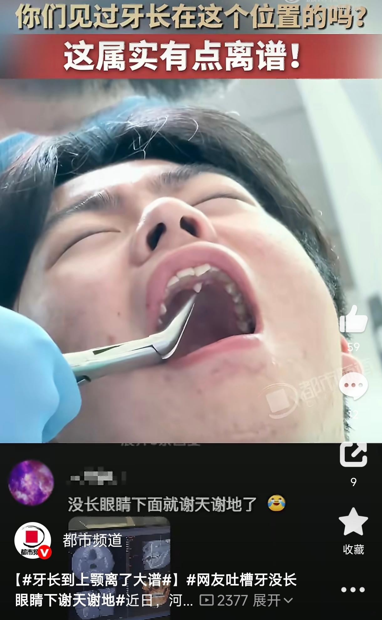 笑不活了！河北一名小伙牙疼去拔牙，医生检查后发现，他的牙齿居然长在了上颚位置。小