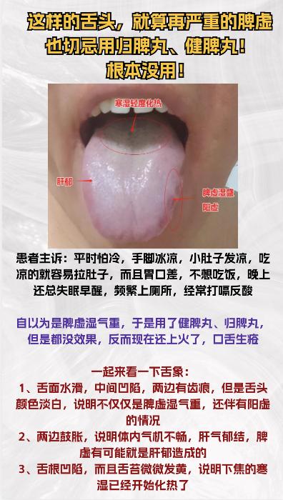 出现这样的舌象，脾虚再严重，也不要吃“归脾丸” “健脾丸”