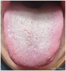 肾虚不可怕，怕就怕你脾肾两虚，掺杂痰湿，想补都补不进去!
患者主诉：那方面虚的一