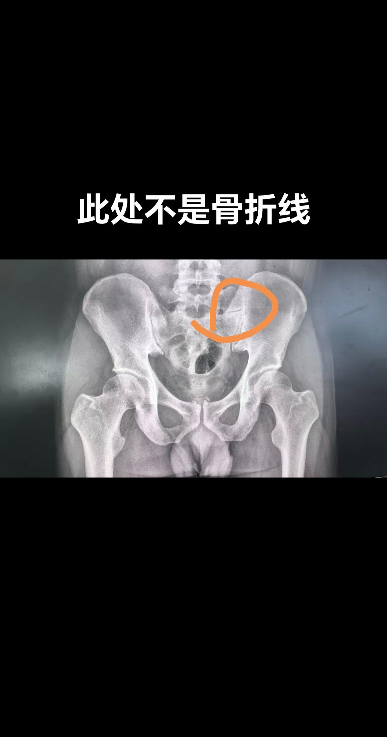 腰骶椎单侧的融合。这是常见的发育障碍，不要误诊为骨折。部分病人可能会出...