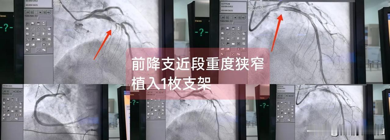 急性ST段抬高型心肌梗死
（前降支近段重度狭窄)

一.概念：
前降支主要为前壁