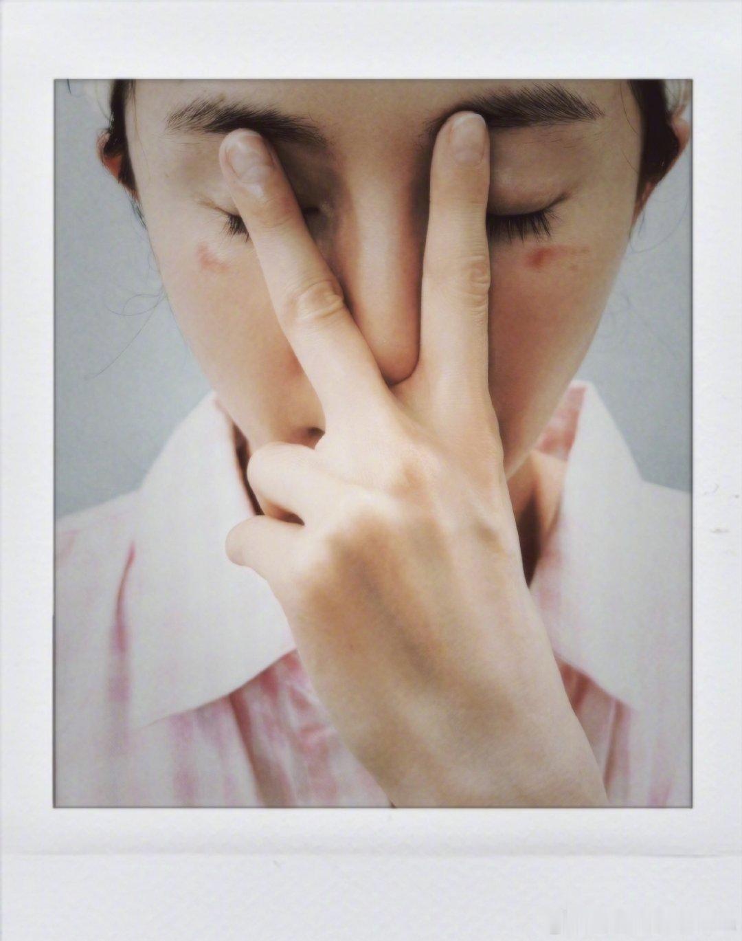 杨幂脸被蒸汽眼罩烫伤了💥杨幂发文调侃蒸汽眼罩咬人🥺眼下出现明显红痕惨遭低温烫