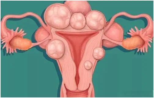 #子宫肌瘤可能是吃出来的#‼️首先要为大豆及豆制品正名：植物雌激素≠雌激素。大豆