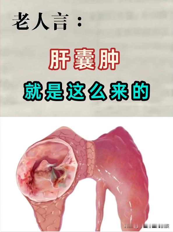 肝囊肿，这么来的

治了一辈子肝囊肿，一分钱没赚到！今天我就把肝囊肿的真相说出来