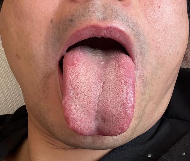张医生我的舌头有问题吗？麻烦您把“吗”去掉好吗[狗头][狗头][狗头]
又是肝郁