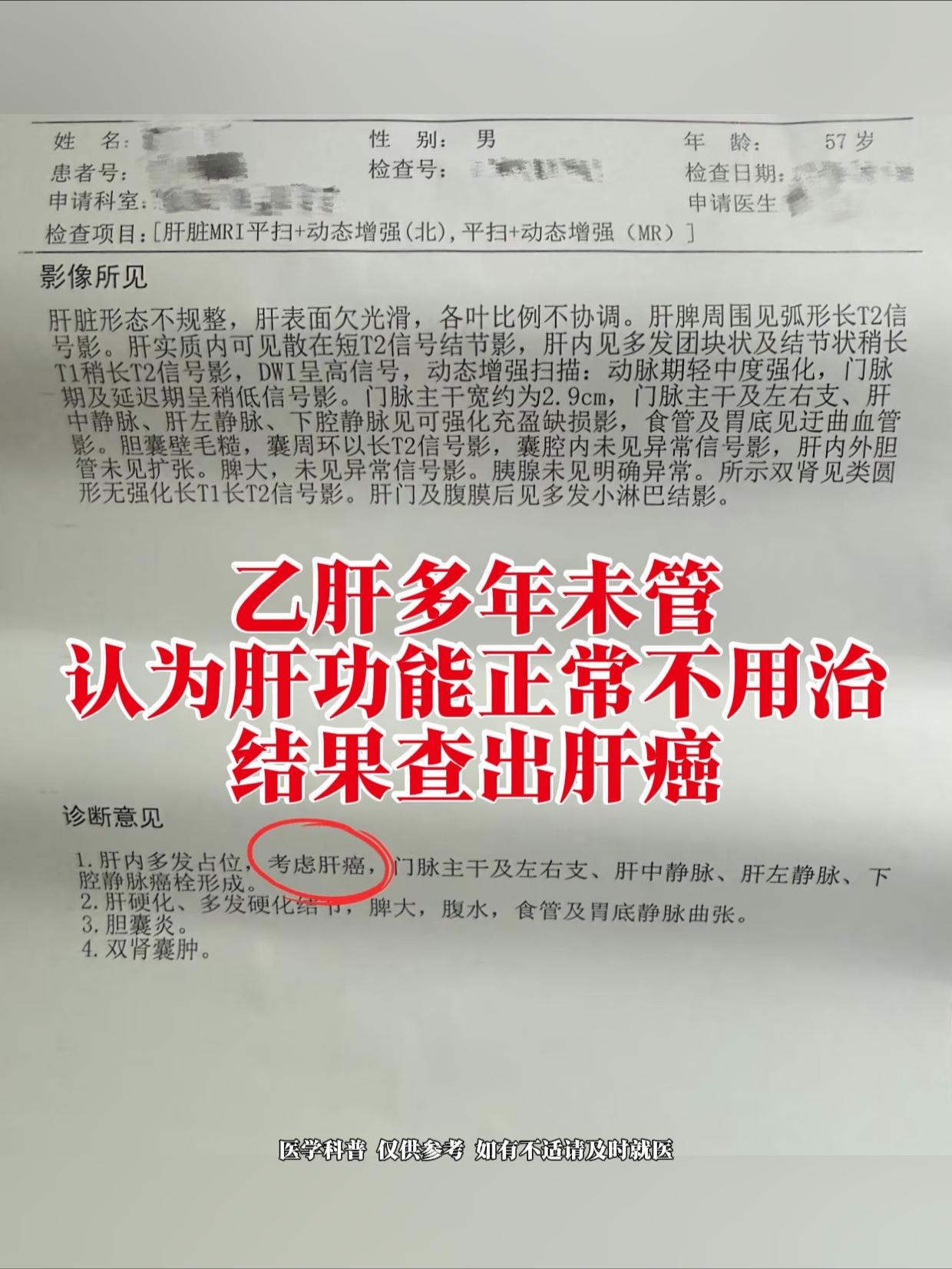 这个患者是二十多岁知道的自己有乙肝，但是当时肝功能正常，当地医生说不用...