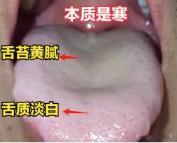 三伏天，祛湿的黄金40天，还不会分寒湿和湿热？两张图教会你
咱们一起来看两张舌象
