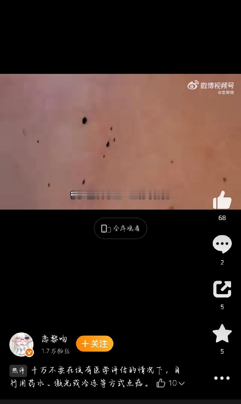 身上长痣很常见，但有些痣可不能掉以轻心，有 5 种痣癌变风险挺高。
首先是不对称