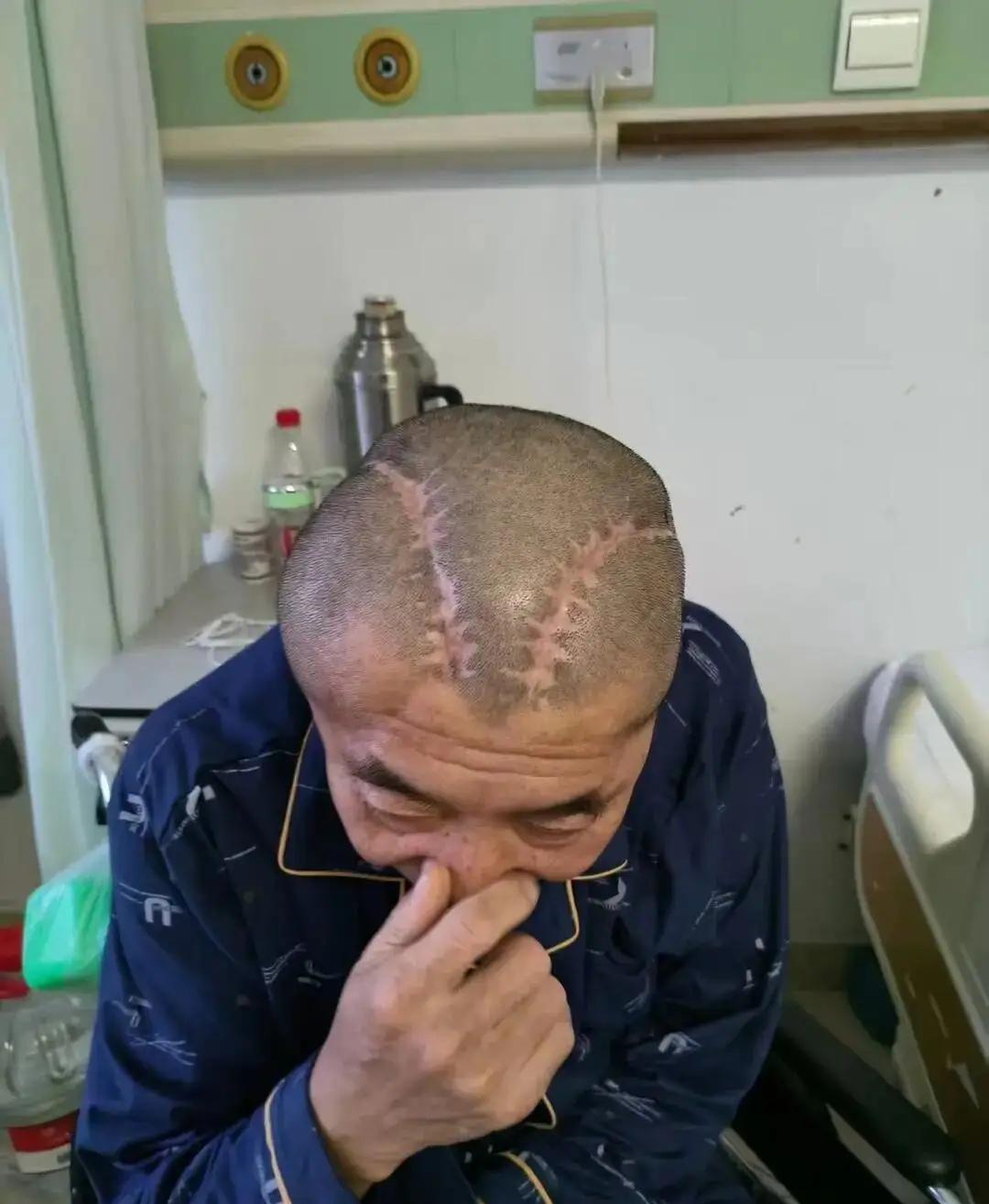 内蒙古包头，一男子右脑脑出血，被送进医院做开颅手术，万万没想到，医生搞错开了左脑