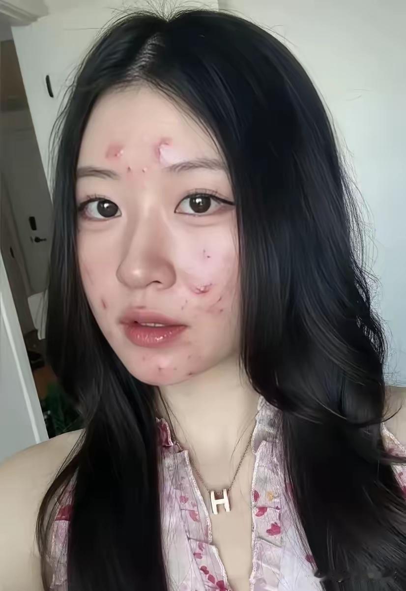 内分泌失调，满脸的痘痘，不影响嫁人，结婚了就好了