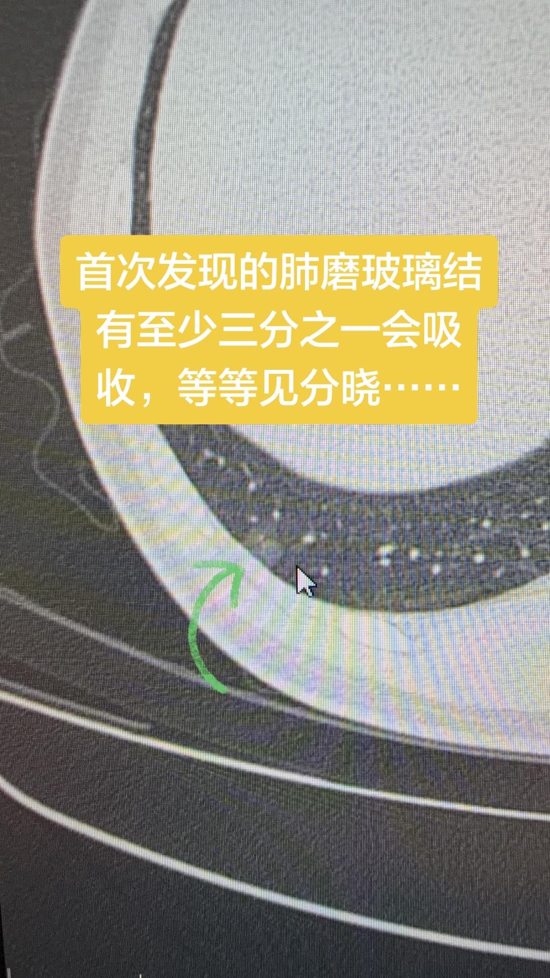 首次发现的肺磨玻璃结有至少三分之一会吸收，等等见分晓……  第二次随访...