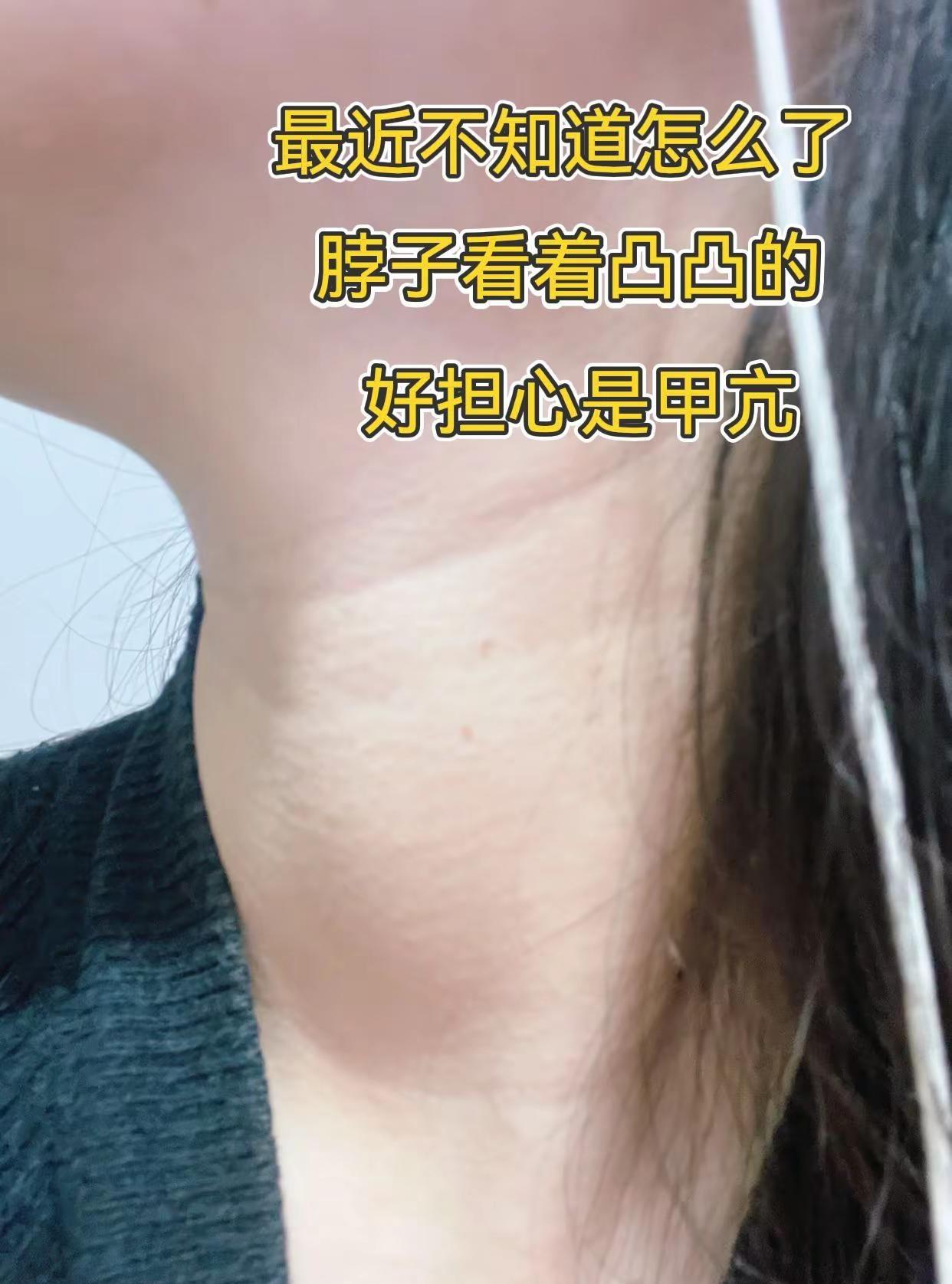 仅为个案建议线下就医。最近不知道怎么了，脖子总感觉突突的😐穿衣服照镜子的时候侧