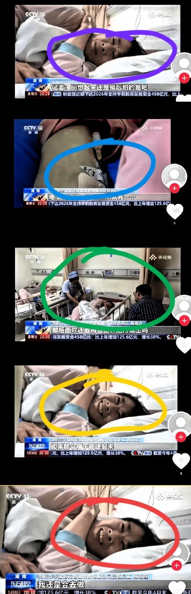 这是央视新闻《东方时空》对湖南浏阳市华盛烟花制造燃放有限公司爆炸事故中受伤员工陈