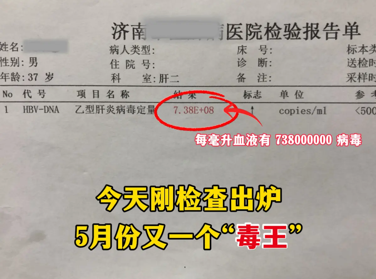 五月份又一个“毒王”，济南本地的小伙子今天来做检查，病毒量8次方，每毫...