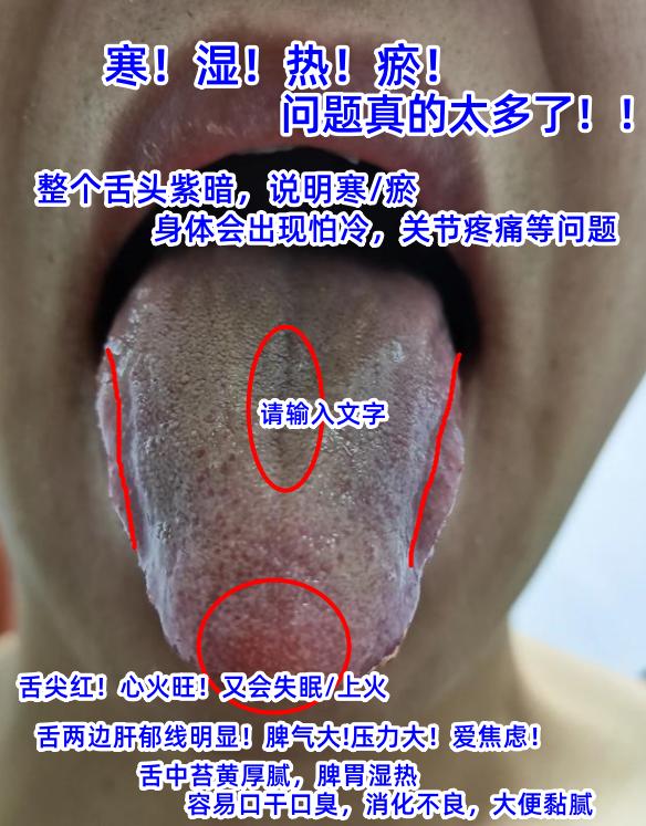今日舌诊案例分析：肝郁气滞，寒湿血瘀，脾胃湿热，脾肾阳虚[谢谢][谢谢][谢谢]
