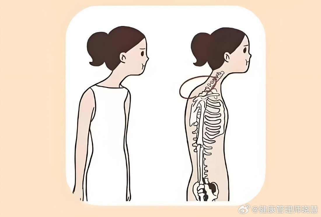 丁禹兮 脖子前倾健闻登顶计划 脖子前倾不仅仅是体态问题，更是身体发出的健康警报。