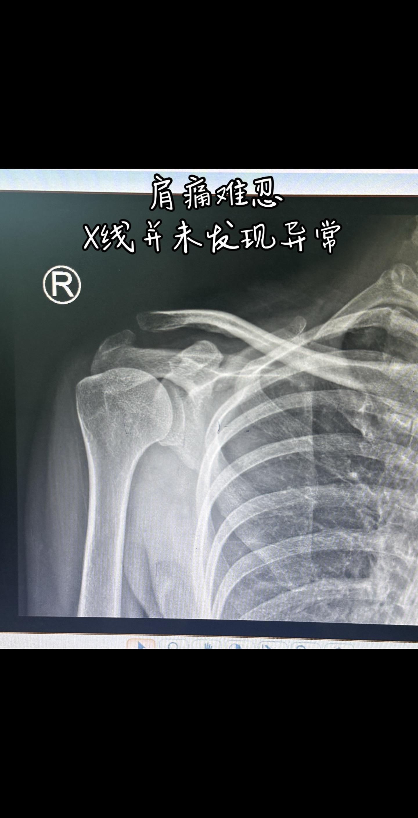 突发肩痛难忍会是什么问题 突发的肩痛难忍，为什么要做核磁