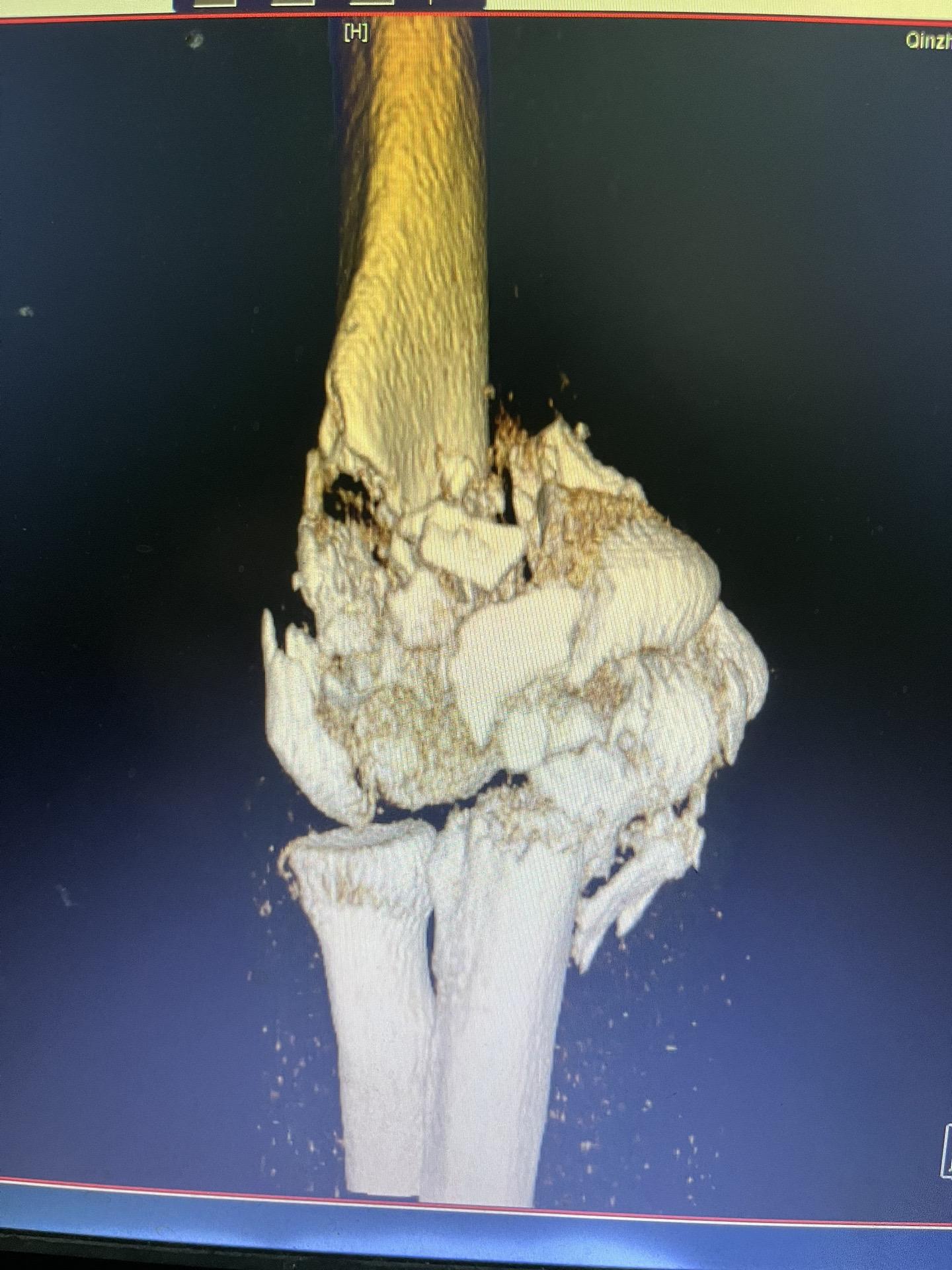 对于极度粉碎性骨折，医生也是只能尽力做好，其他只能是后面慢慢恢复了，该...