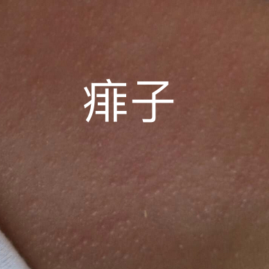 同样是红疹子，湿疹常常和痱子搞混。#儿童健康守护计划# 痱子夏季较常见，冬季由于