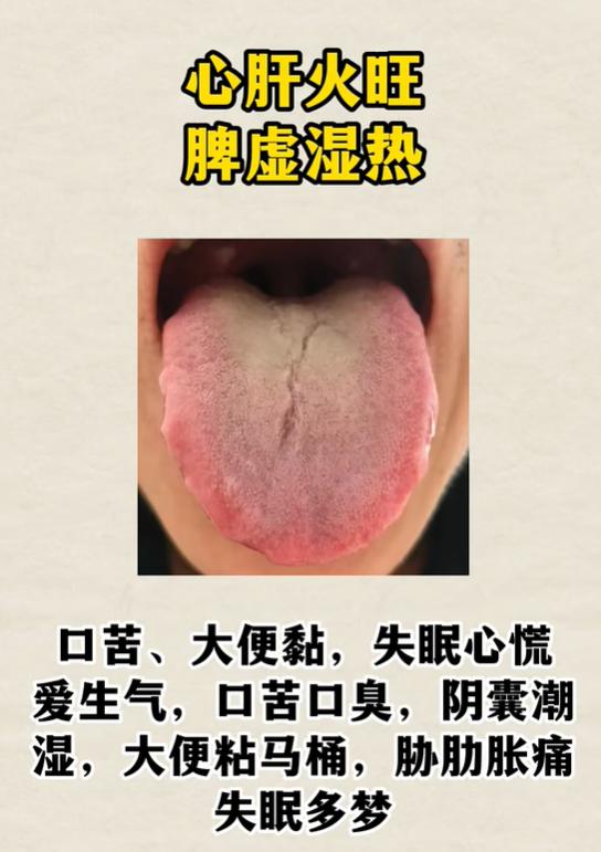 口苦阴囊潮湿、生气就腹胀，三种齿痕舌对应不同体内问题