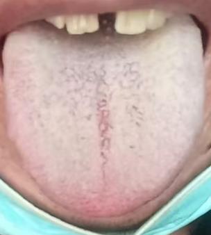 腰椎间盘突出中医调养思路，循序渐进分步改善不适





对于腰间盘突出这个问题