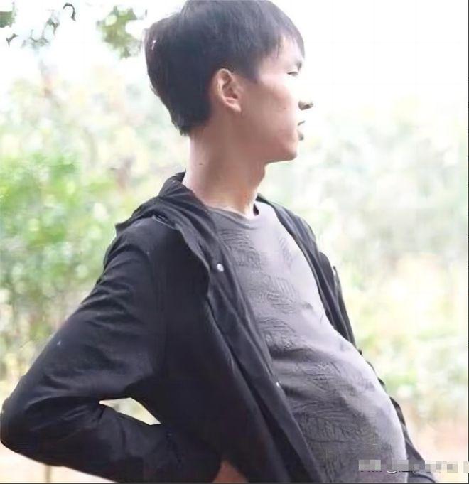 人言可畏！2003年，重庆一小伙整天挺着个大肚子，“剖腹产”之后竟然真的生下来一