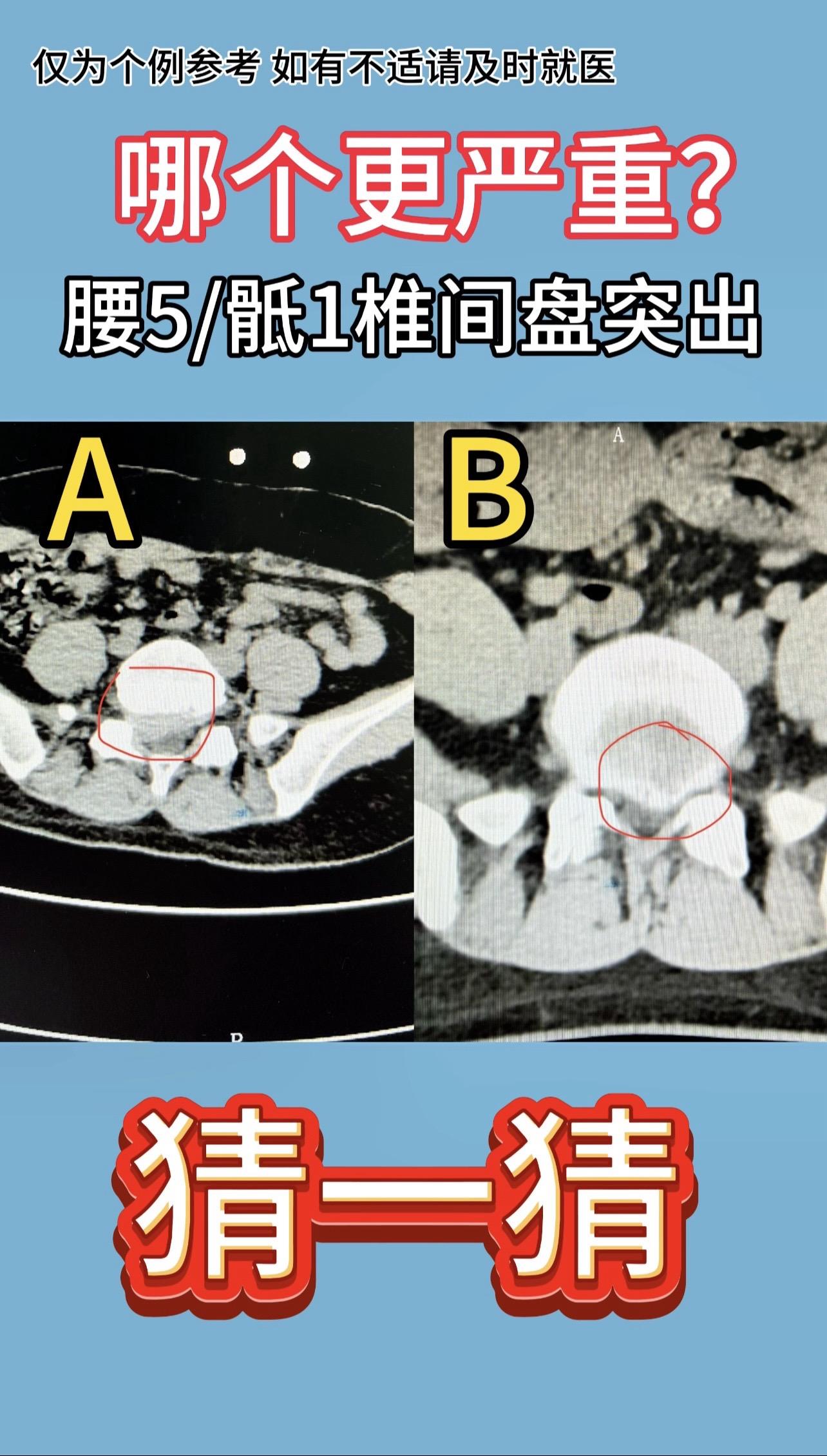 同样的腰5/骶1椎间盘突出，大家猜一猜，是哪个患者的症状重呢？