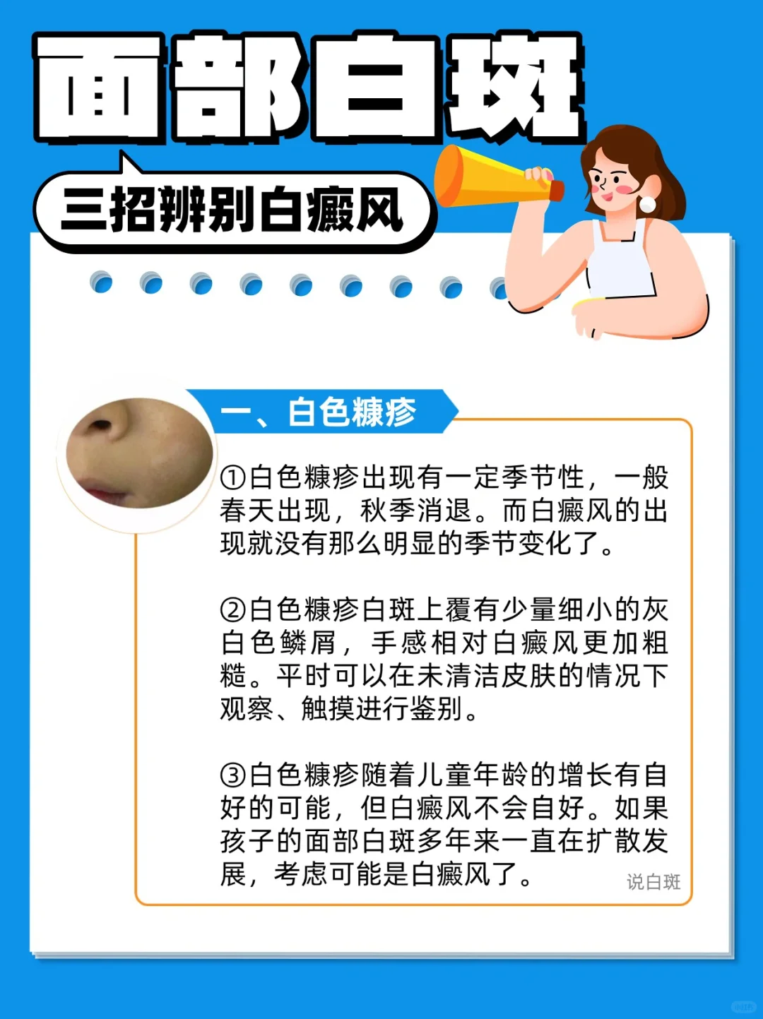 面部白斑这么多，三招辨别白癜风！