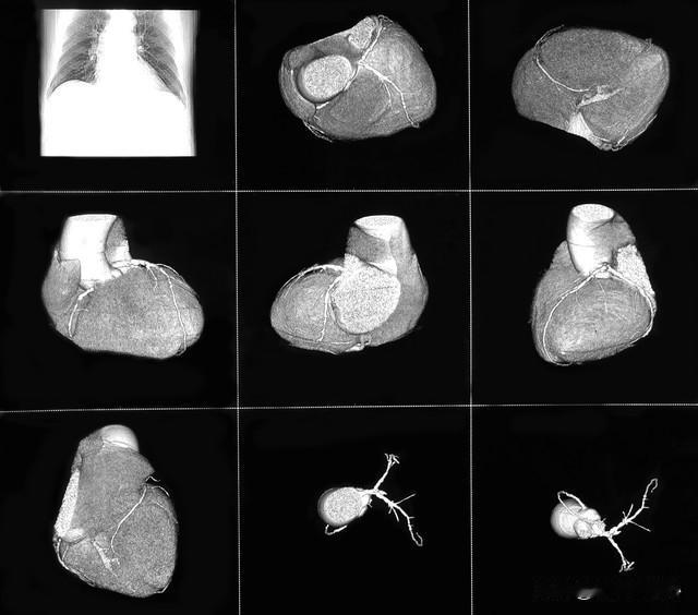 岁，女性，最近两个月总是心前区不适症状，也说不出来到底是胸闷还是胸痛。查血脂偏高