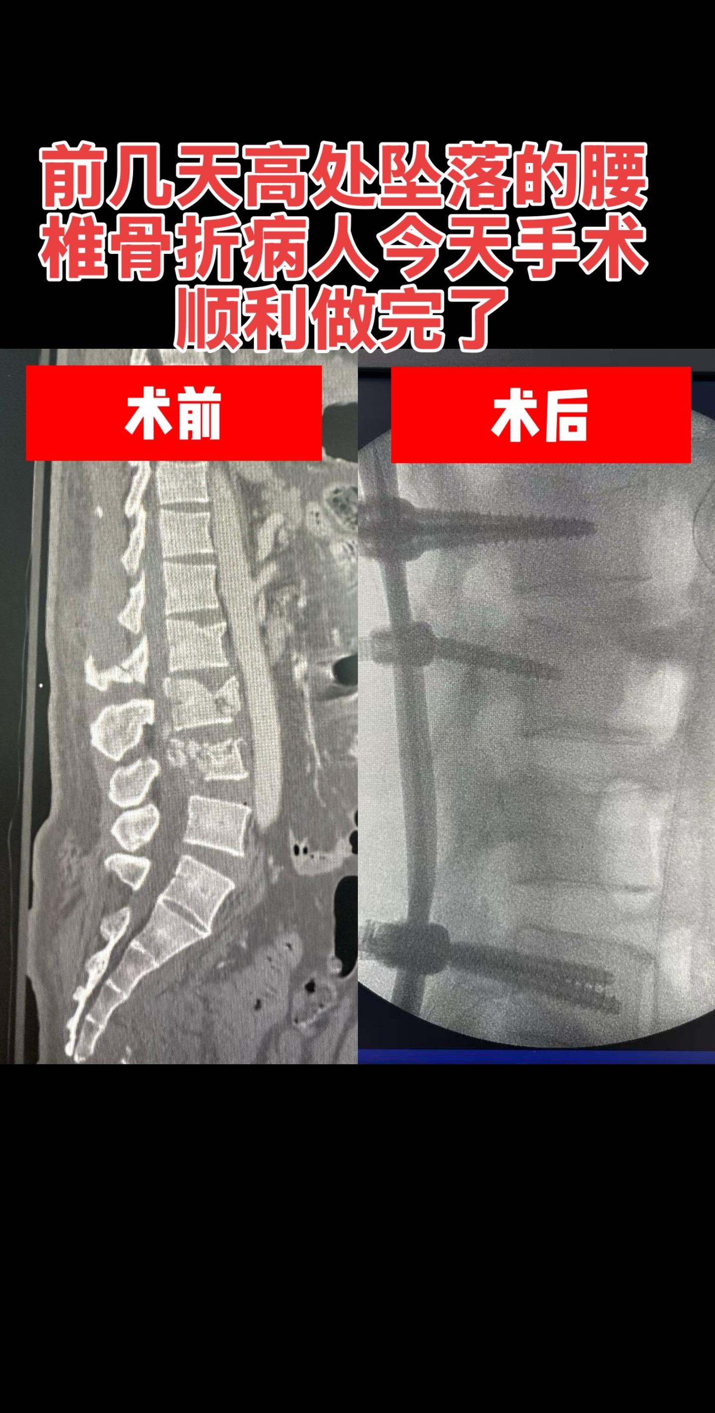 前几天高处坠落导致腰椎爆裂骨折的病人，今天给他做了一个后路撑开复位椎弓...