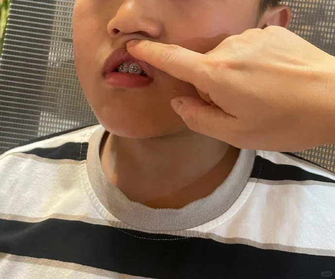 我们都随了我妈，逃不掉要箍牙的命运。