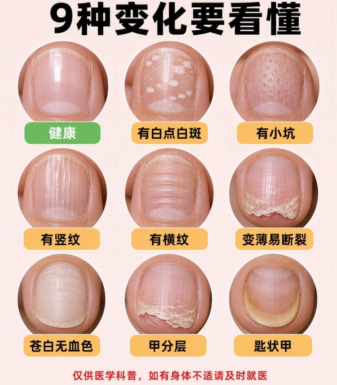 别再忽略指甲发出的信号！一张图看懂指甲9种异常变化。
白点白斑、指甲带小坑、竖纹