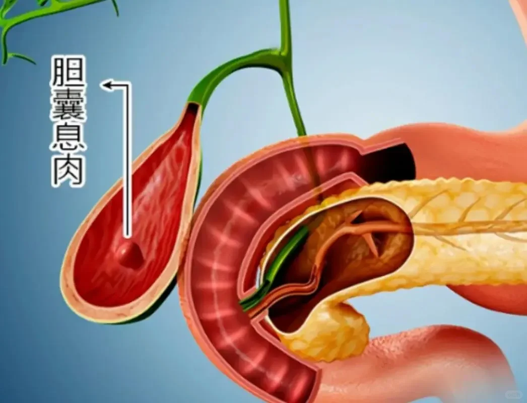 【胆囊息肉】不一定良性、恶性，早筛早诊要知道