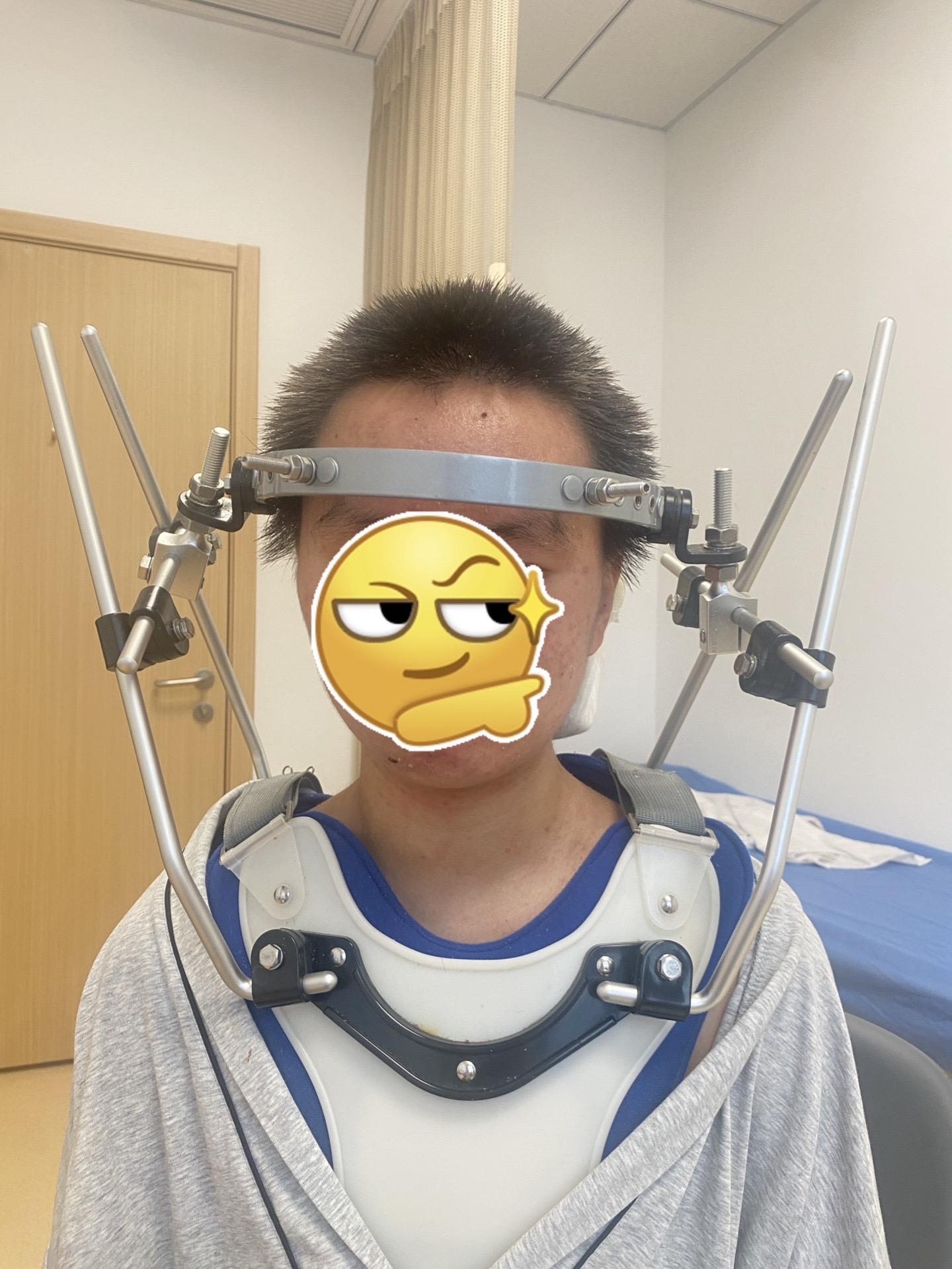 天线宝宝上线。halo架。2型齿状突骨折，以保守难愈合为特点，老年人一...