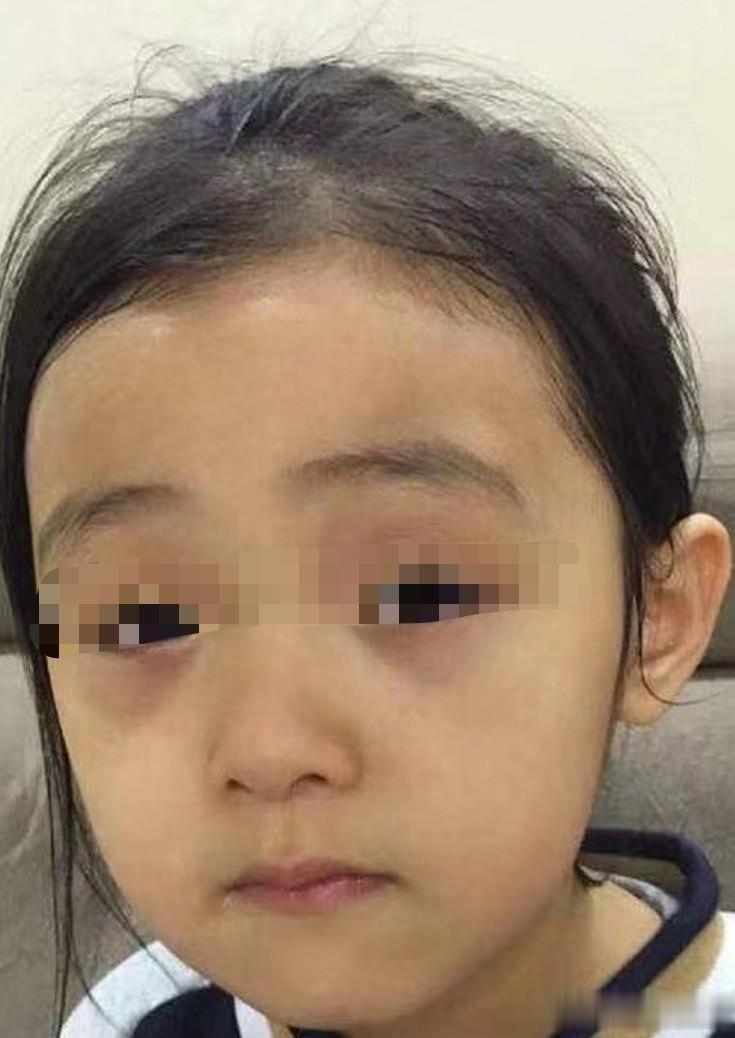 【家长提问】孩子面色发黄，蔫蔫的，两个眼袋发青紫，还“鼓”起来了，嗓子里有痰，经