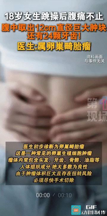 “太吓人了——腹中竟取出24颗牙齿！”湖南长沙，一18岁女孩因为跳操后腹痛难忍，