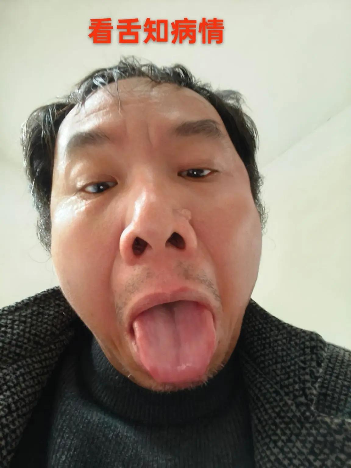 看舌知病情，你看看这舌，我却看着像牛魔王。