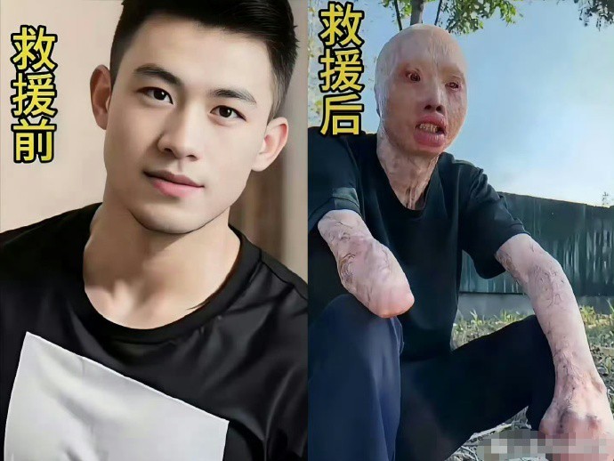 救火英雄救援前后照片，太心疼了！向英雄致敬！！ ​​​