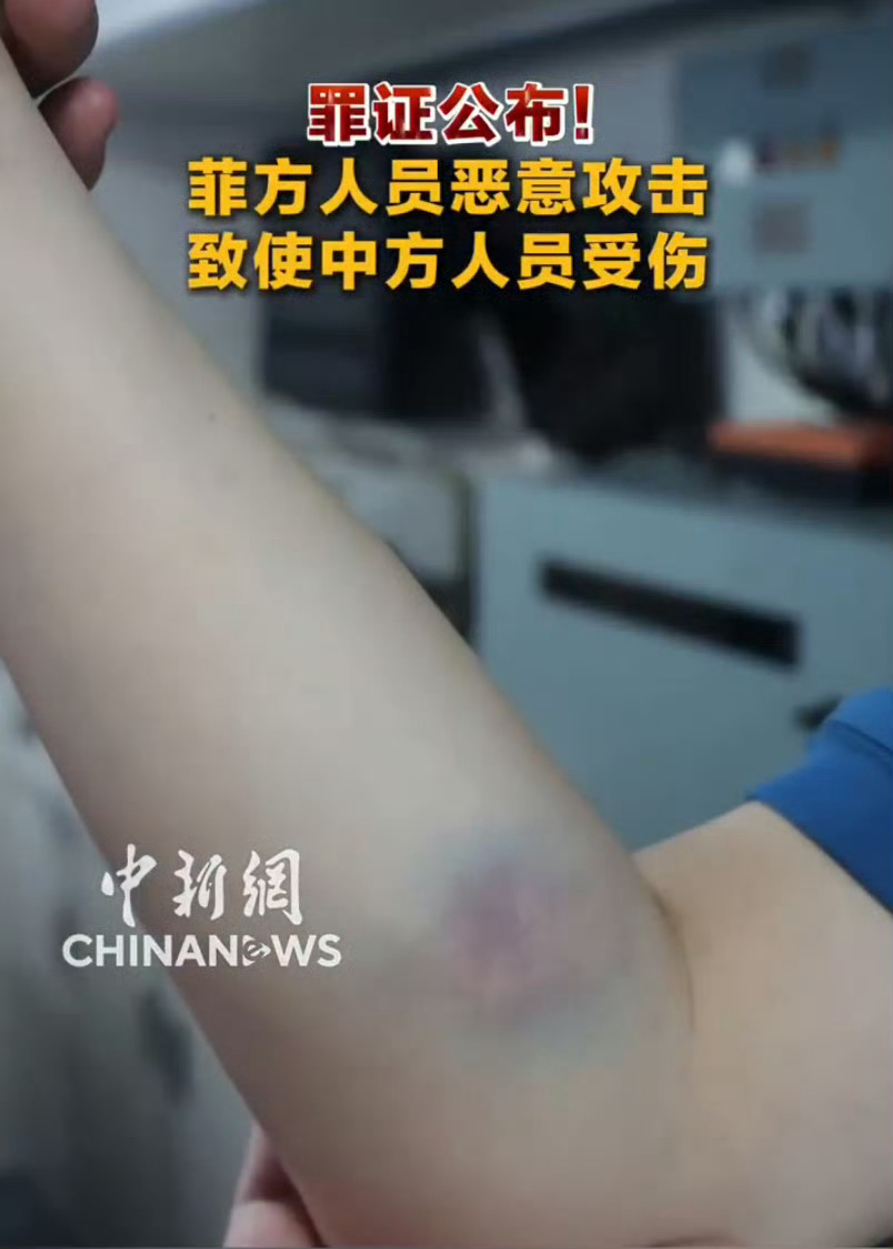 中国海警遭菲律宾海军人员船桨袭击受伤！热点观点菲方恶意攻击致使中方人员受伤